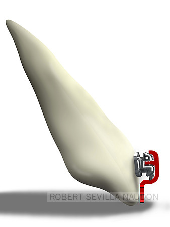 Tooth_Bracket_Side_300dpi